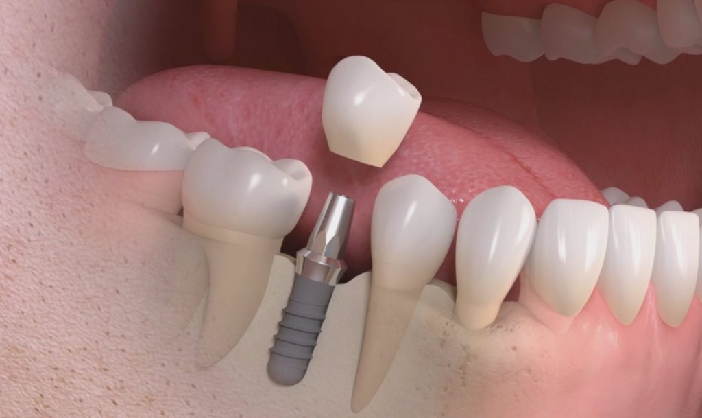 Implantologia Dentale