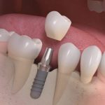 Implantologia Dentale: la tecnica minimamente invasiva