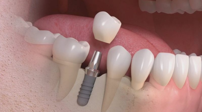Implantologia Dentale